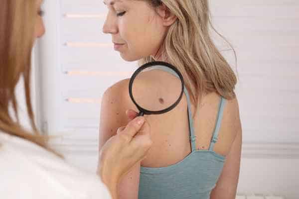 What Are Traditional Skin Lesion Removal Methods Welwyn Garden City?