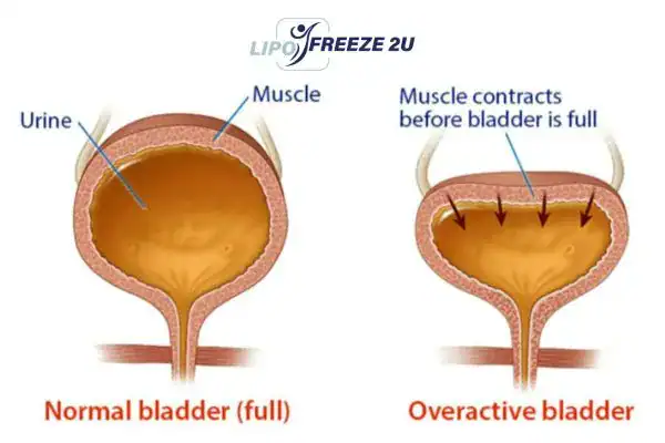 diagram of overactive bladder treatment Welwyn Garden City