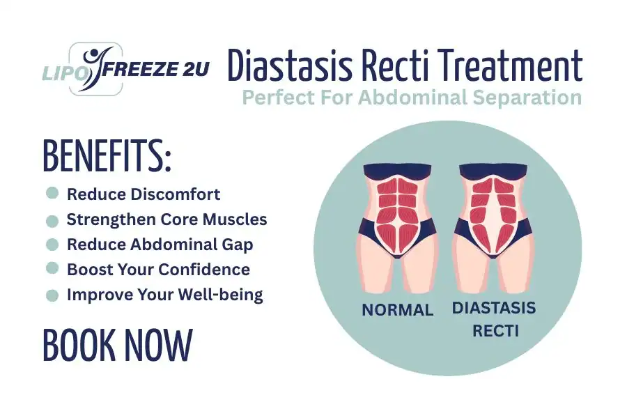 How Long Will It Take to See Improvements in Diastasis Recti Welwyn Garden City