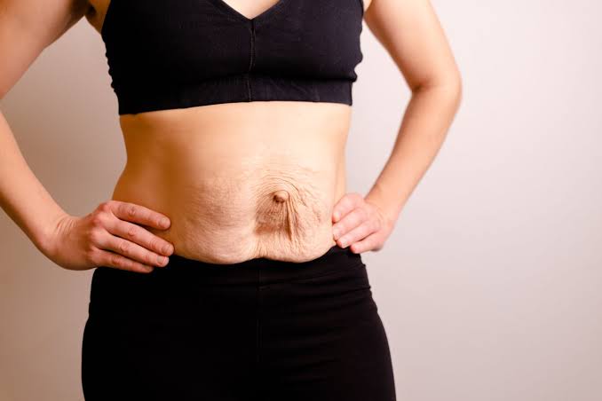 Is Surgery Really the Only Way to Repair Diastasis Recti Welwyn Garden City?