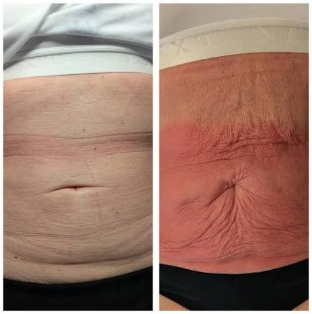 How Does RF Microneedling Improve Crepey, Thin and Uneven Skin Texture Welwyn Garden City?