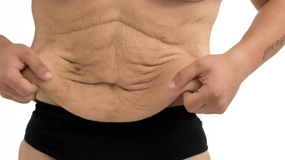 RF Microneedling for Loose Skin: How Can It Help Tighten and Reshape the Skin Welwyn Garden City?